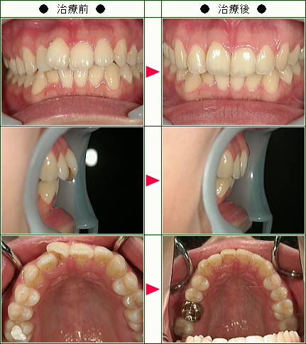歯のデコボコ矯正症例(Ｍ.Ｓ様　２６歳　女性)