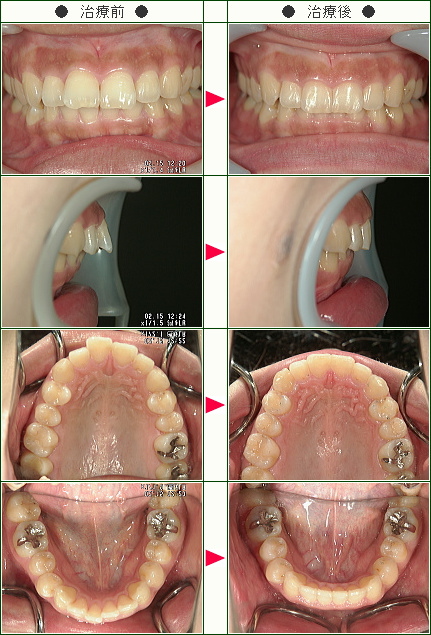 出っ歯矯正症例(Ｍ.Ｓ様　２７歳　女性)