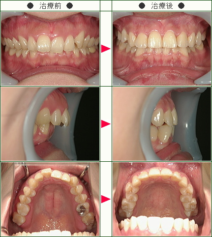 歯のデコボコ矯正症例(Ｍ．Ｓ様　３１歳　女性)