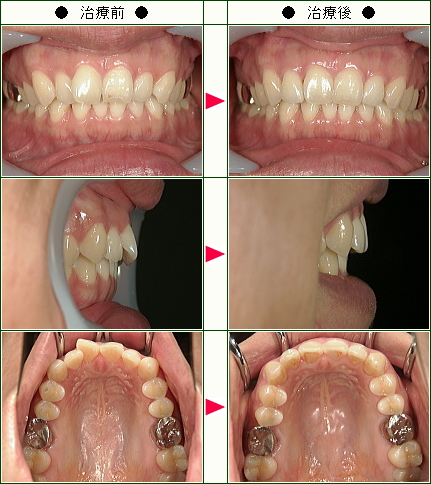 歯のデコボコ矯正症例(Ｍ・Ｓ様　３６歳　女性)
