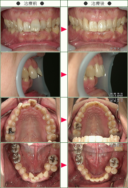 出っ歯矯正症例(Ｍ.Ｓ様　４２歳　男性)