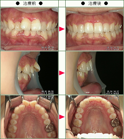 出っ歯矯正症例(Ｍ.Ｔ様　２３歳　女性)