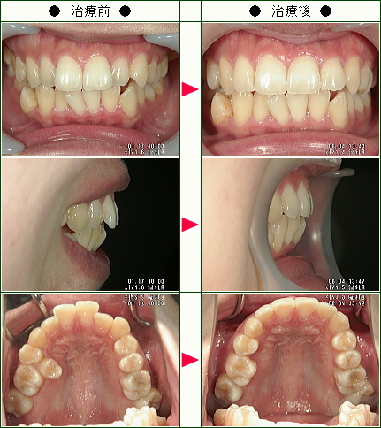 歯のデコボコ矯正症例(Ｍ.Ｔ様　２５歳　女性)