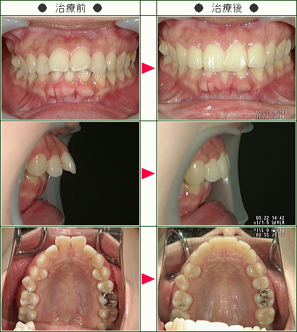 出っ歯矯正症例(Ｍ.Ｔ様　２７歳　女性)