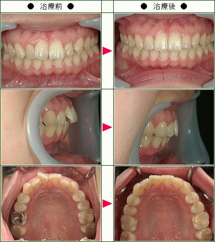 歯のデコボコ矯正症例(Ｍ.Ｔ様　２８歳　女性)