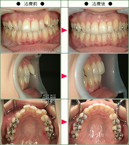 歯のデコボコ矯正症例(Ｍ.Ｔ様　２９歳　女性)