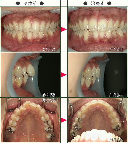 歯のデコボコ矯正症例(Ｍ.Ｔ様　３０歳　女性)