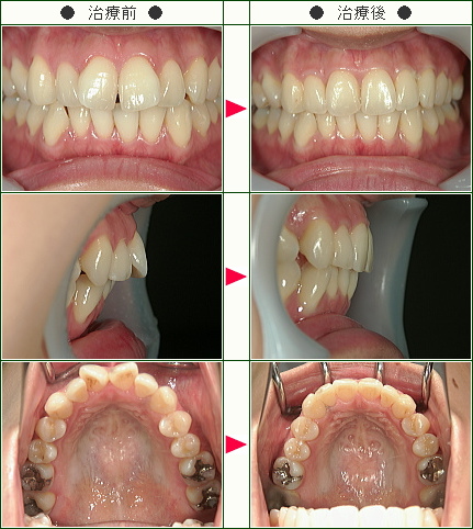 出っ歯矯正症例(Ｍ.Ｔ様　３０歳　女性)