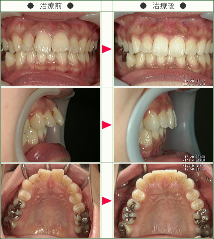 出っ歯矯正症例(Ｍ．Ｔ様　３２歳　女性)