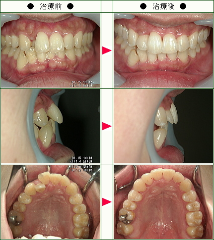 歯のデコボコ矯正症例(Ｍ・Ｔ様　３６歳　女性)