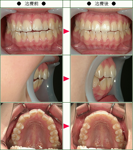 歯のデコボコ矯正症例(Ｍ．Ｕ様　２１歳　女性)