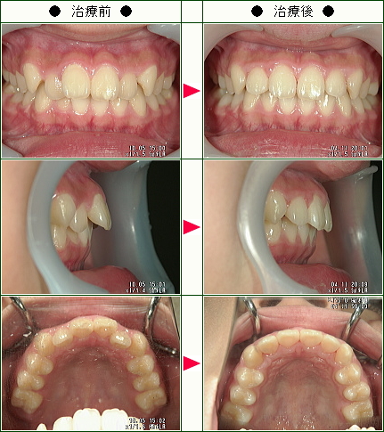 歯のデコボコ矯正症例(宗村様　１１歳　女性)