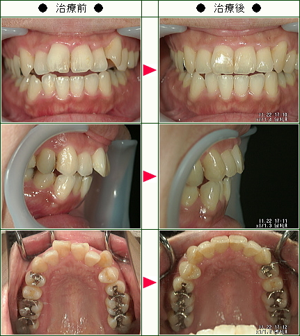 歯のデコボコ矯正症例(ムラタ様　３７歳　女性)