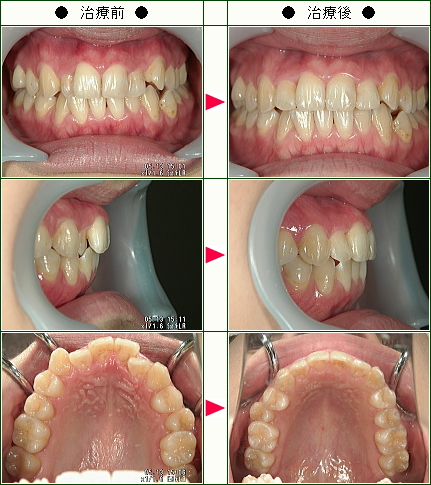 歯のデコボコ矯正症例(Ｍ.Ｙ様　２２歳　女性)
