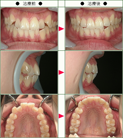 歯のデコボコ矯正症例(Ｍ・Ｙ様　２４歳　女性)