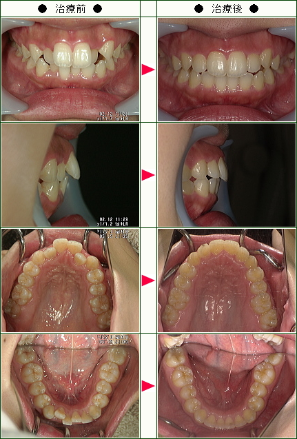 歯のデコボコ矯正症例(Ｍ．Ｙ様　２５歳　女性)