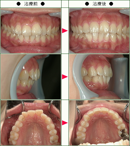 歯のデコボコ矯正症例(Ｍ・Ｙ様　２６歳　女性)