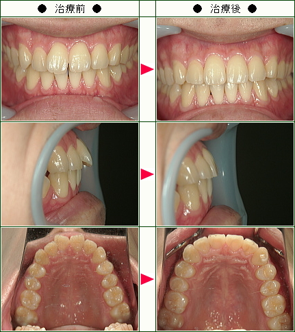 歯のデコボコ矯正症例(Ｍ．Ｙ様　２６歳　男性)
