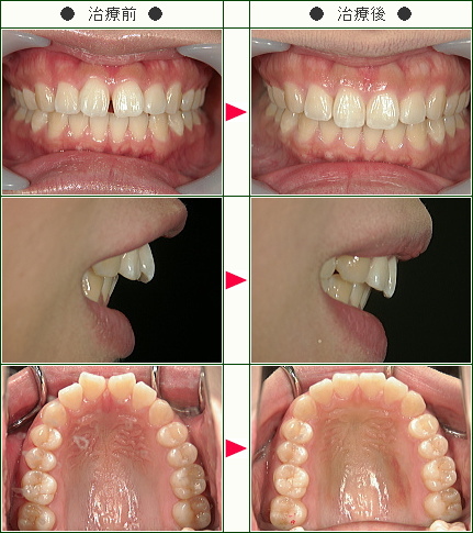前歯のすきっ歯矯正症例(Ｍ.Ｙ様　２７歳　女性)