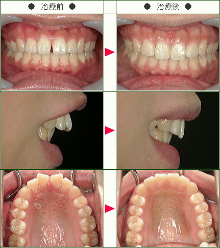 前歯のすきっ歯矯正症例 歳から39歳まで 2
