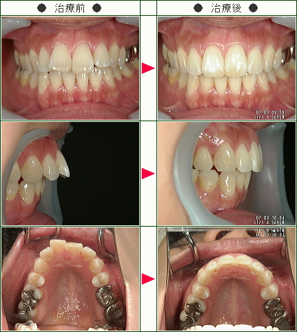 出っ歯矯正症例(Ｍ．Ｙ様　３６歳　女性)