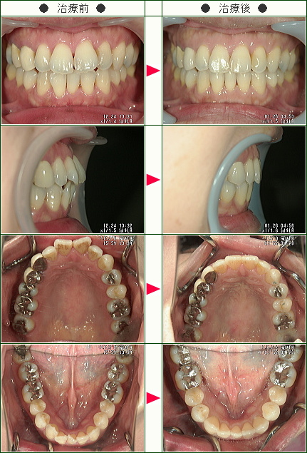 歯のデコボコ矯正症例(Ｍ．Ｙ様　３８歳　女性)