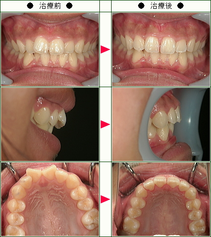 歯のデコボコ矯正症例(Ｍ・Ｙ様　女性（母親）)