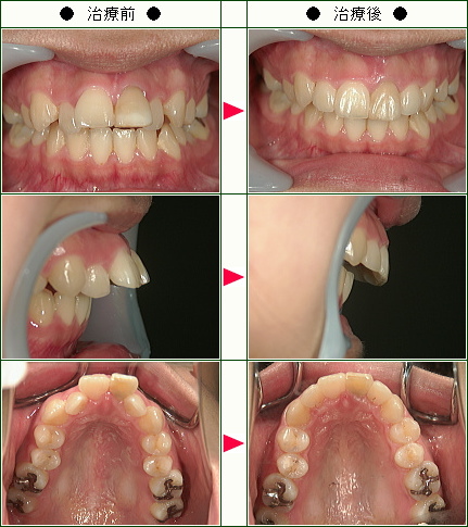 出っ歯矯正症例(Ｎ様　２０歳　女性)