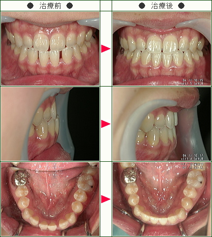 前歯のすきっ歯矯正症例-20歳から39歳まで(1)