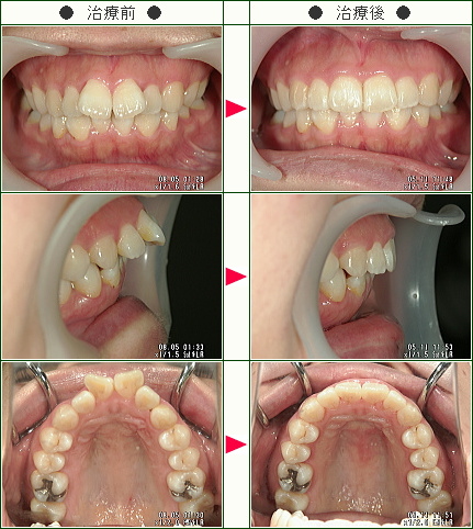 出っ歯矯正症例(Ｎ様　３２歳　女性)
