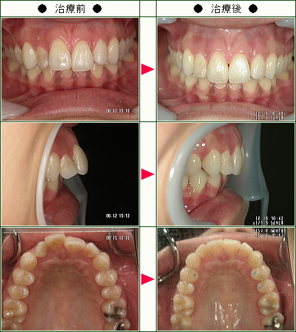 出っ歯矯正症例(ｎ_ｎ様　３１歳　女性)