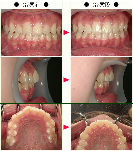 歯のデコボコ矯正症例(Ｎ.Ａ様　１４歳　女性)