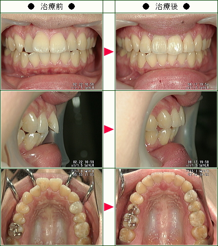 歯のデコボコ矯正症例(Ｎ・Ａ様　２７歳　女性)