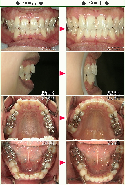 歯のデコボコ矯正症例(Ｎ．Ａ様　３１歳　女性)