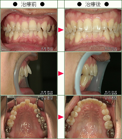 歯のデコボコ矯正症例(永井様　３４歳　男性)