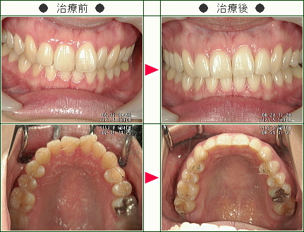 歯のデコボコ矯正症例(長嶋様　２２歳　女性)