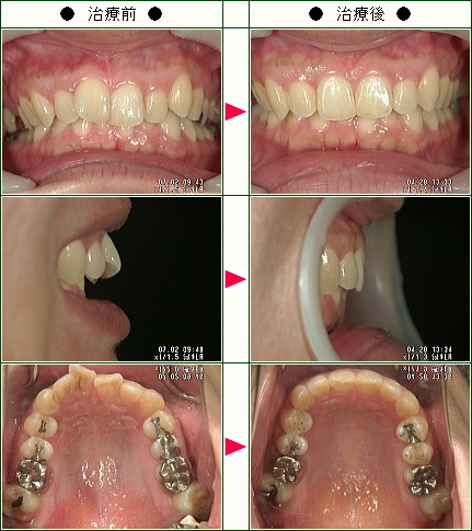 歯のデコボコ矯正症例(なか様　３７歳　女性)