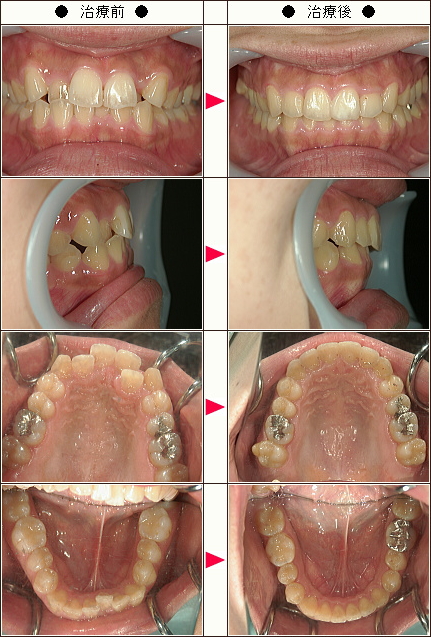 歯のデコボコ矯正症例［中島様　２８歳　女性］