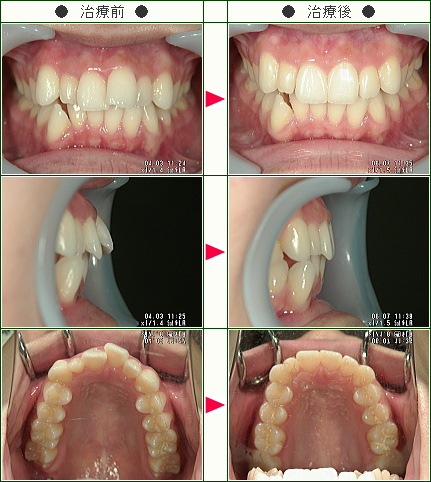 出っ歯矯正症例(中村様　１９歳　女性)