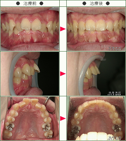 出っ歯矯正症例(ナカムラ様　２６歳　男性)