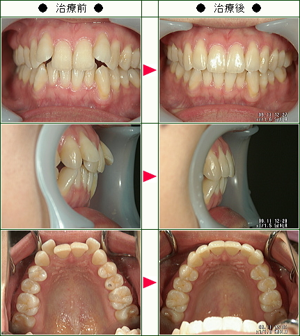 歯のデコボコ矯正症例(中村様　２８歳　女性)