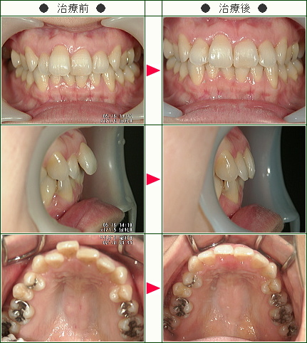 歯のデコボコ矯正症例(ナカムラ様　３９歳　女性)