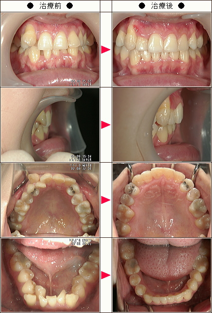 歯のデコボコ矯正症例［中田様　２９歳　女性］