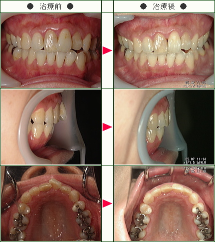 歯のデコボコ矯正症例(直子様　３８歳　女性)