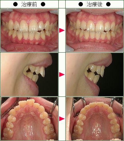 歯のデコボコ矯正症例(直美様　１９歳　女性)