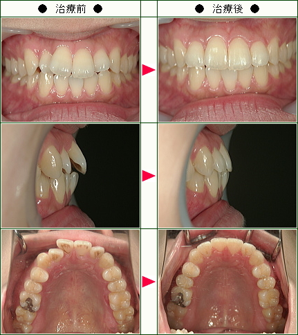 歯のデコボコ矯正症例(Ｎ.Ｂ様　２９歳　女性)