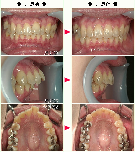 歯のデコボコ矯正症例(Ｎ・Ｅ様　２７歳　女性)