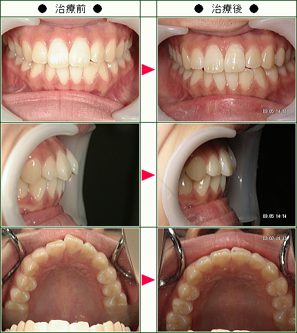 歯のデコボコ矯正症例(ねこ様　２２歳　女性)