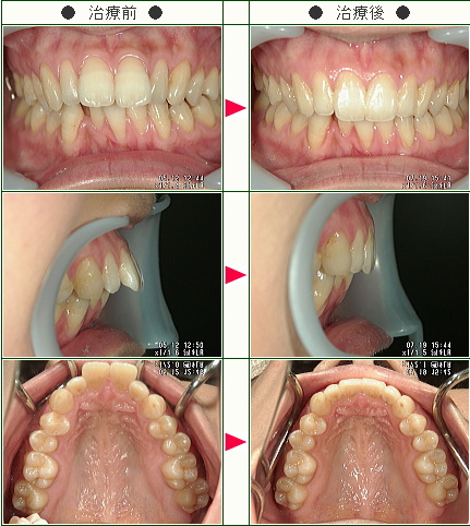 出っ歯矯正症例(ねこねこねこ様　２８歳　女性)