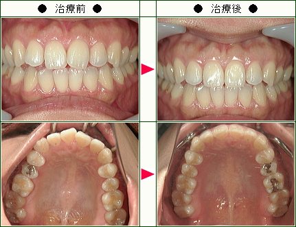 歯のデコボコ矯正症例(Ｎ.Ｈ様　３５歳　女性)